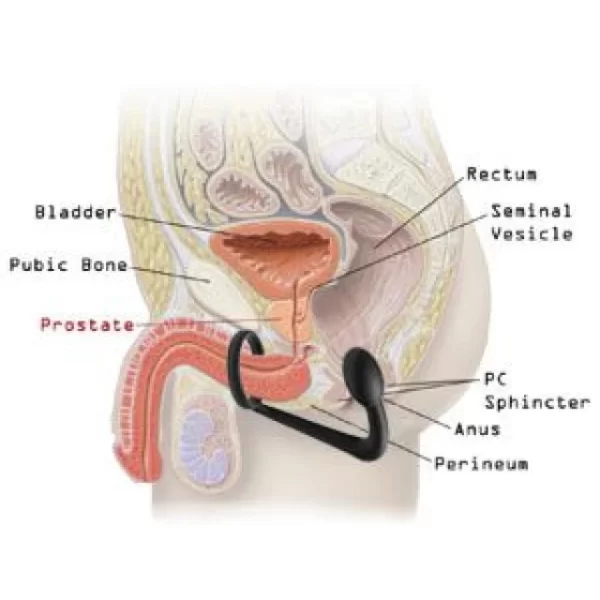 Plug prostatique pour une stimulation intense